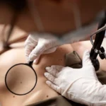 Usuwanie Kaszaków i Tłuszczaków - dr n. med. Urszula Mikulska